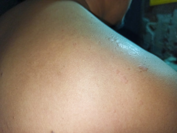 一名男子露出受皮肤病影响的背部。图片下载