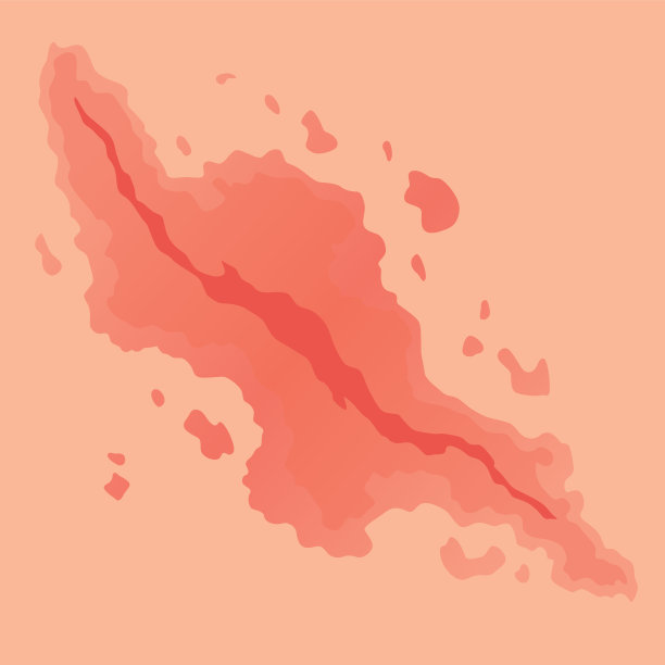 牛皮癣病媒的类型。部分患者皮肤出现皮炎、炎症、红疹等皮肤问题。疾病概念的卡通插图图片下载