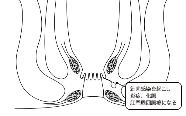 肛门、痔疮疾病《肛肠痔疮》插图，横切面图图片下载
