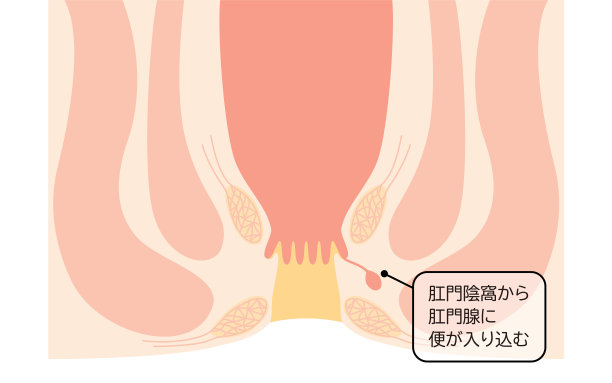 肛门、痔疮疾病《肛肠痔疮》插图，横切面图图片下载