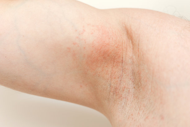 过敏腋下。在使用剃刀、修剪器、有毒除臭剂或止汗剂后，敏感皮肤上的刺激和炎症的裁剪照片。腋窝皮疹。特应性皮炎。痤疮或红斑。图片下载