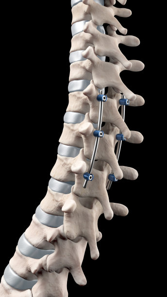 椎弓根螺钉和棒椎后路胸椎融合图片下载