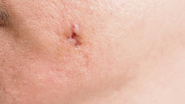 面部脓肿或大的痤疮手术留下的疤痕。医学治疗后皮肤发炎留下的疤痕。接近脸上的疤痕或问题皮肤。图为治疗大脓肿和痤疮后的照片。图片下载