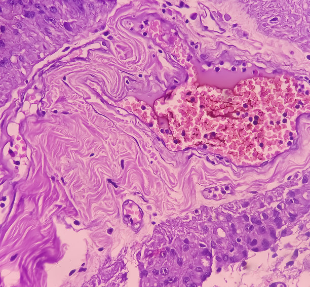 星形细胞瘤，髓内SOL (C5-D3)组织活检。显微照片显示恶性肿瘤卵圆形到细长的细胞，细胞核偏心，嗜酸性细胞。Micovascular增殖。图片下载