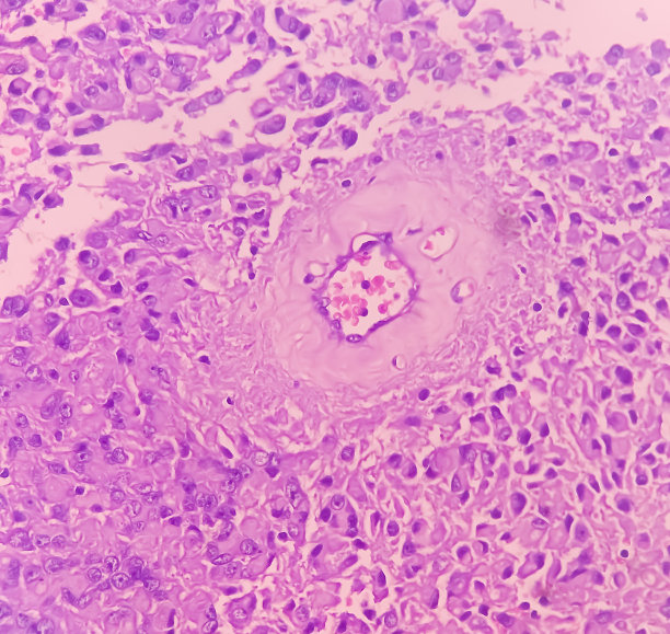 星形细胞瘤，髓内SOL (C5-D3)组织活检。显微照片显示恶性肿瘤卵圆形到细长的细胞，细胞核偏心，嗜酸性细胞。Micovascular增殖。图片下载