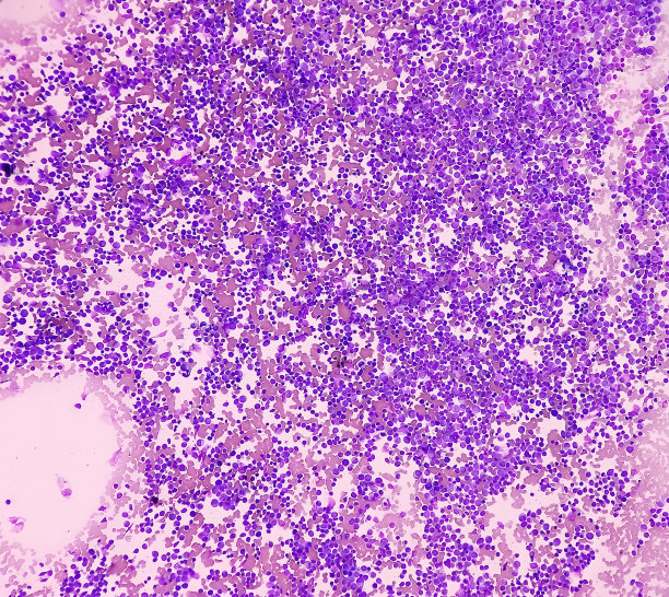血液癌症。急性髓母细胞白血病(AML)显微照片，一种白细胞癌。骨髓研究。BMS涂片镜检。图片下载