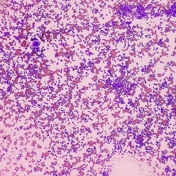 血液癌症。急性髓母细胞白血病(AML)显微照片，一种白细胞癌。骨髓研究。BMS涂片镜检。图片下载