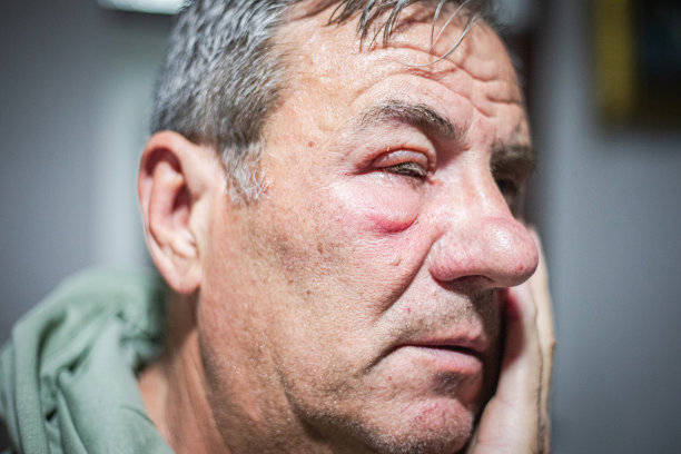 男脸红肿，虫咬过敏图片下载