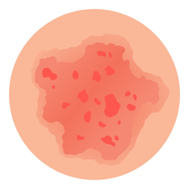 牛皮癣病媒的类型。部分患者皮肤出现皮炎、炎症、红疹等皮肤问题。疾病概念的卡通插图图片下载