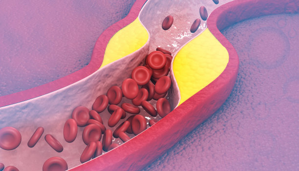 血液中胆固醇含量高图片下载