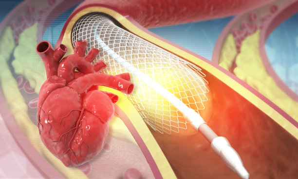 人心脏血管成形术支架图片下载