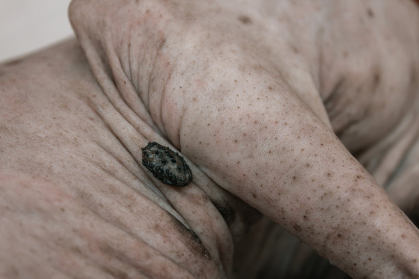 一只皮肤上长了肿瘤的斯芬克斯黑猫的特写照片。猫的乳头状瘤和病毒图片下载