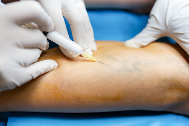 一名戴着外科手套的医生正在进行用于消除静脉曲张的硬化疗法。静脉注射:将溶液直接注入静脉库存图片图片下载