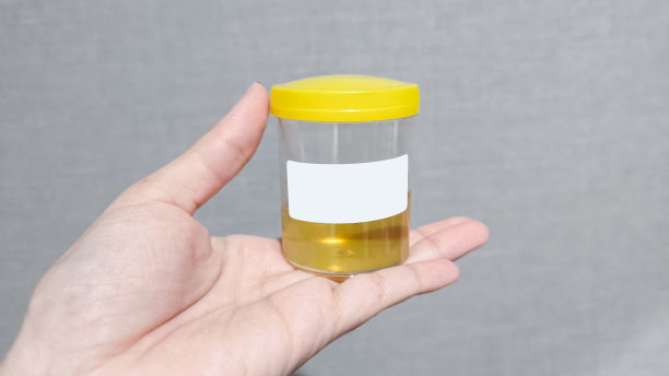 尿样分析在一个罐子在手。泌尿科，肾脏疾病和尿路感染的概念。图片下载