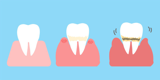 牙周病的进展牙齿的简单插图图片下载