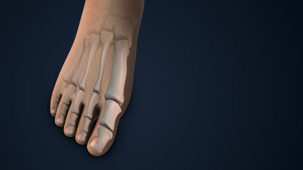 足部拇外翻矫正术图片下载