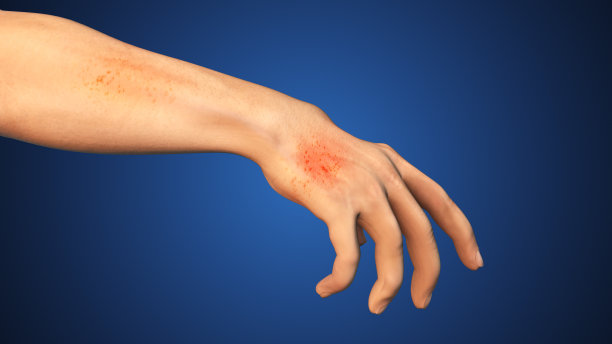 手部皮肤湿疹的医学概念图片下载