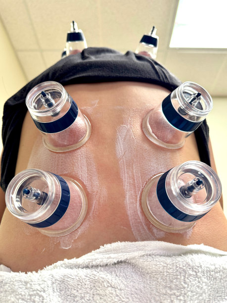 拔火罐疗法_7图片下载