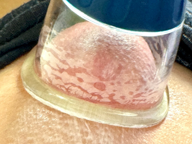 拔火罐Therapy_10图片下载