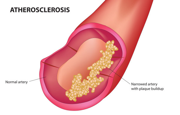 动脉粥样硬化图片下载