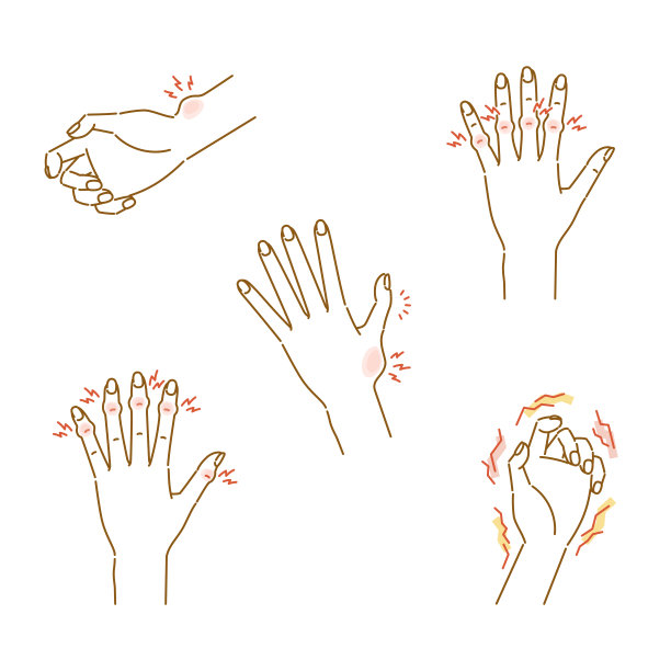 妇女更年期失调:手指关节疼痛、肿胀和变形的插图图片下载