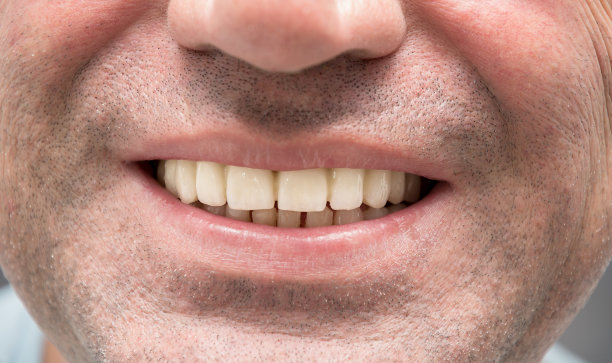 一个人的真实照片后，他的上牙修复与套筒义齿。一个男人在医生的办公室满意地笑着，炫耀他的新牙。特写镜头。图片下载