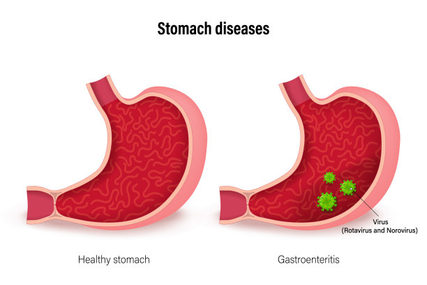 胃部疾病。健康胃与肠胃炎的比较。胃肠道功能紊乱。肠胃感冒。用于科学和医学教育的媒介。图片下载