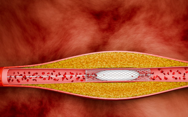 血管成形术治疗心脏病。高脂血症或动脉硬化。动脉闭塞的概念和人体血管作为一种疾病与胆固醇斑块脂肪堆积堵塞。三维渲染图片下载