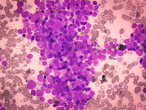血液癌症。急性白血病的显微照片，一种白细胞癌。骨髓研究图片下载