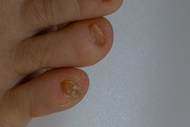 指甲真菌感染甲真菌病腿部皮肤干燥粗糙图片下载