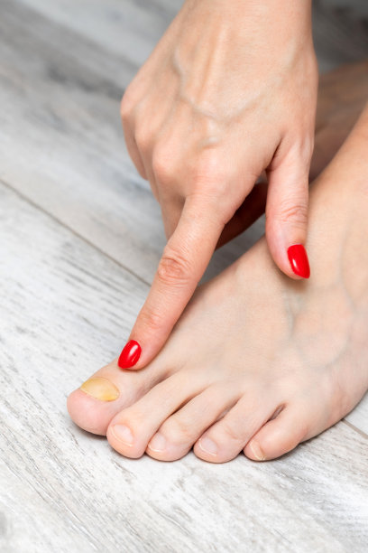 一个女人在检查她大脚趾上的角，垂直照片。图片下载