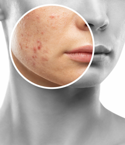 一个皮肤有问题的年轻女孩。痤疮治疗前后的照片。图片下载