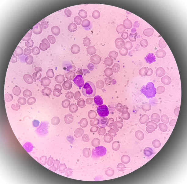 血液癌症。急性白血病的显微照片，一种白细胞癌。骨髓研究图片下载