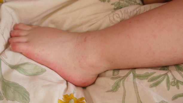 足部因手足口病而起疹子图片下载