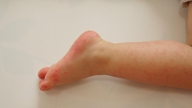 足部因手足口病而起疹子图片下载