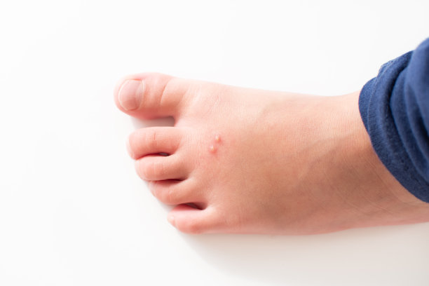 被昆虫咬伤的孩子的脚。火蚁咬伤图片下载