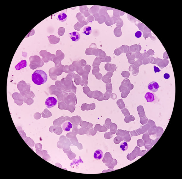 骨髓活动正常。巨核细胞大小正常，数量充足。正常的活跃骨髓。B细胞淋巴母细胞淋巴瘤患者。图片下载