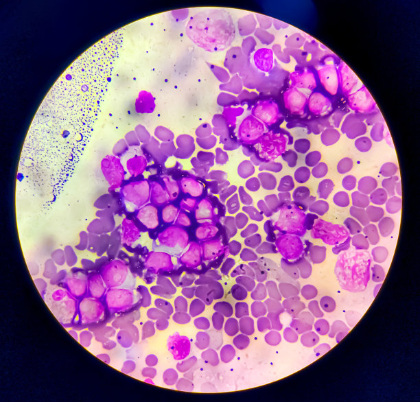 急性淋巴细胞白血病(ALL)成熟b细胞光镜分析。图片下载