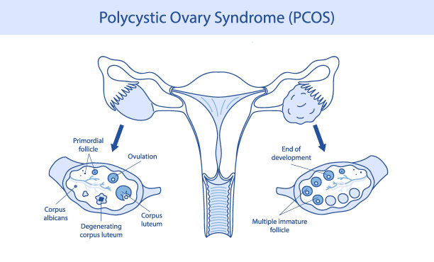 多囊卵巢综合征。女性系统的卵巢囊肿。新年插画是手绘的。图片下载