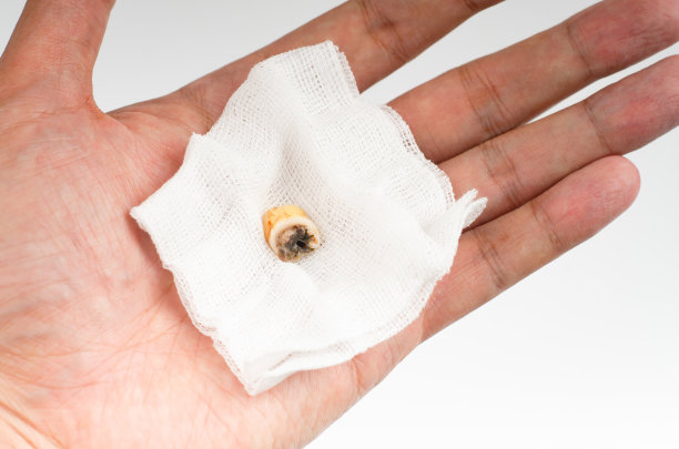 拔牙是在白色纱布上，牙科外科概念，拔牙的微距照片，用纱布垫。图片下载