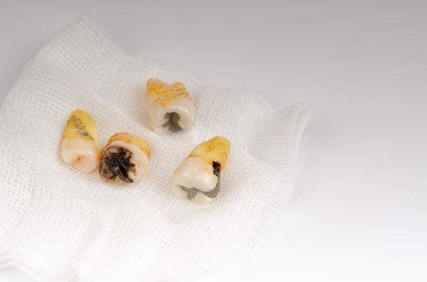 拔牙是在白色纱布上，牙科外科概念，拔牙的微距照片，用纱布垫。图片下载