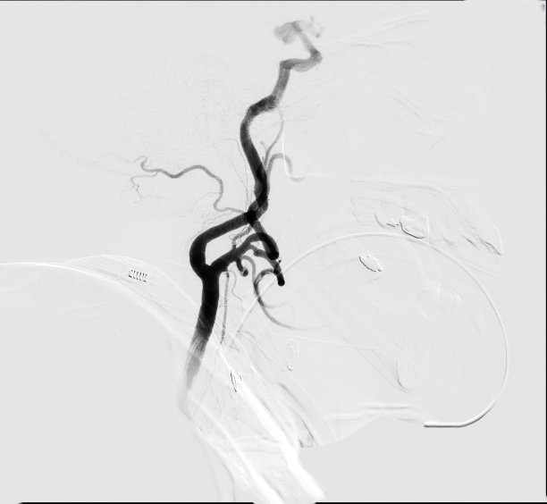 脑血管造影是一种专门的程序，以可视化的动脉和静脉在大脑中的医学诊断。图片下载