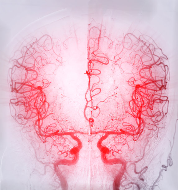 脑血管造影是一种专门的程序，以可视化的动脉和静脉在大脑中的医学诊断。图片下载
