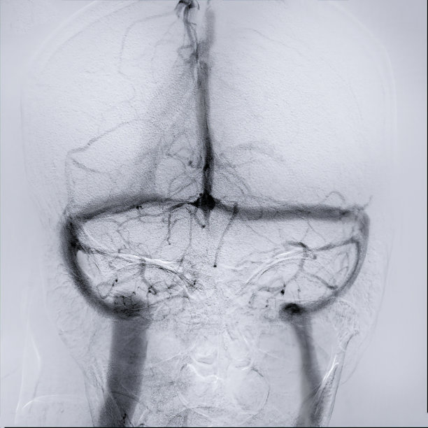 脑血管造影提供了大脑静脉系统的详细图像，有助于诊断。图片下载
