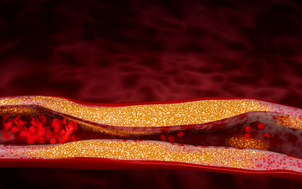 高脂血症或动脉硬化。动脉阻塞的概念和人体血管作为一种疾病与胆固醇脂肪堆积堵塞。动脉阻塞，动脉中的胆固醇斑块。三维渲染图片下载