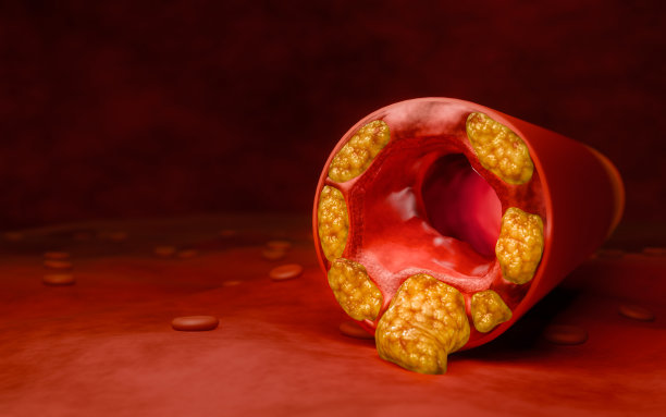 高脂血症或动脉硬化。动脉阻塞的概念和人体血管作为一种疾病与胆固醇脂肪堆积堵塞。动脉阻塞，动脉中的胆固醇斑块。三维渲染图片下载