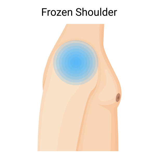 肩冻综合征，症状和治疗，矢量插图图片下载