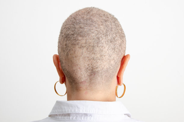 化疗40天后的严重脱发女性头部后视图（医疗照片）图片下载