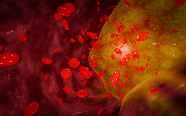 高脂血症或动脉硬化。动脉阻塞的概念和人体血管作为一种疾病与胆固醇脂肪堆积堵塞。动脉阻塞，动脉中的胆固醇斑块。三维渲染图片下载