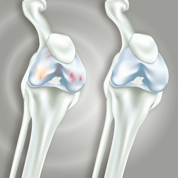 膝关节置换术图片下载